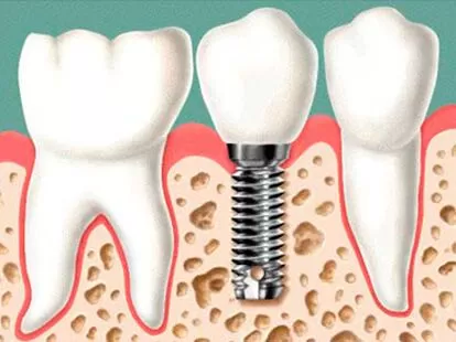 Implantes 